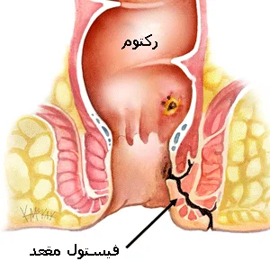 فیستول مقعدی