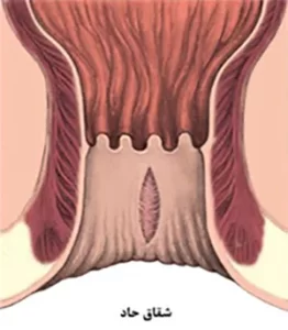 فیشر یا شقاق مقعدی حاد