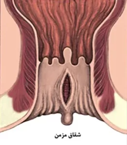 فیشر یا شقاق مقعدی مزمن
