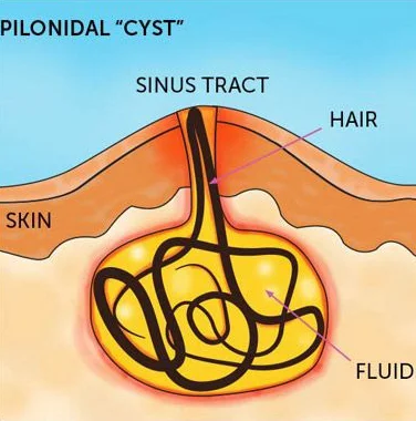 سینوس پیلونیوال کیست مویی